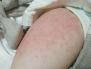 幼儿急疹的症状是什么，怎么护理