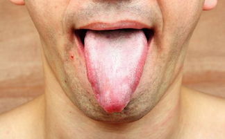舌头有齿痕是怎么回事