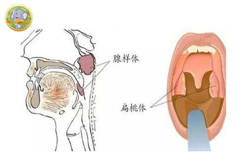 小孩腺样体肥大会有什么危害 宝宝鼻炎的危害 0 7岁宝宝护理知识