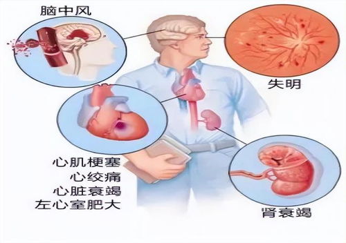 高血压最危险的类型 高压高低压低,什么原因引起的 该怎么办