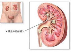 _四川结石病医院