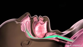 宁波首发 人们为什么晚上喜欢张口呼吸 