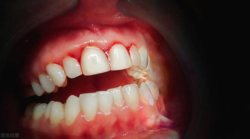 无药可救的 坏牙 最终还是拔掉了 缺牙位置怎么办