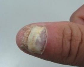 指甲扁平苔癣的致病因素有哪些