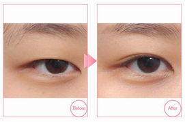 广州割双眼皮的手术过程怎么样 如何让眼睛更大