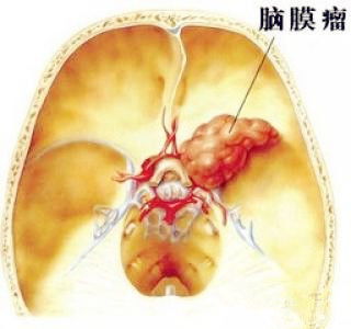 脑膜瘤可怕吗怎么治疗