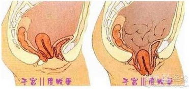 子宫脱垂妇科专家建议手术(取环能同时把子宫下垂复位吗要多少钱)(子宫下垂环要拿吗)