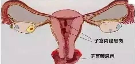 子宫息肉的症状，子宫息肉的症状有哪些