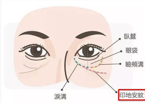 印第安纹图片是什么样的,泪沟凹陷严重都到脸颊了是印第安纹吗