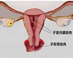 黄石多囊卵巢综合症的禁忌有哪些