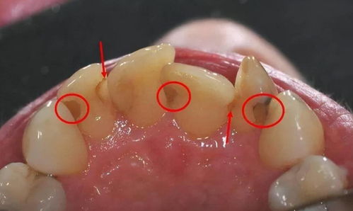 牙结石 可以自己抠掉吗 教你几招,牙缝的脏东西或能轻松掉