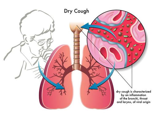 咳嗽,咳痰,慢性支气管炎反复发作怎么办
