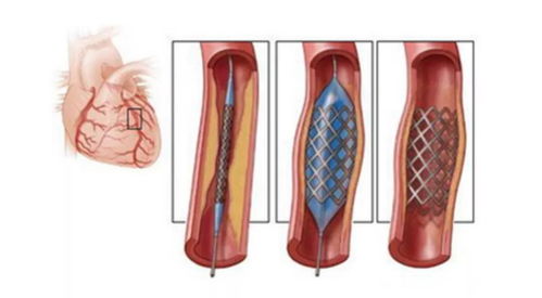 集美健康 怎样维护心脏支架