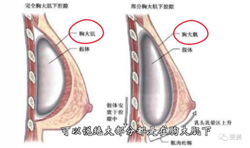 为什么医院不建议取假体