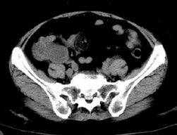 阑尾粘液腺癌 Appendix mucinous adenocarcinoma CT病例