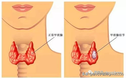 读完此文,甲状腺结节不再纠结