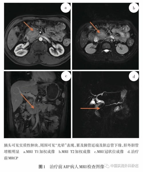 论著 自身免疫性胰腺炎22例临床诊治分析