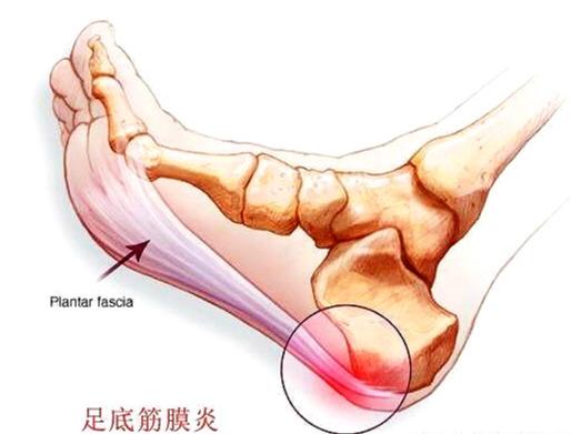 脚底疼痛部位图解足底 搜狗图片搜索