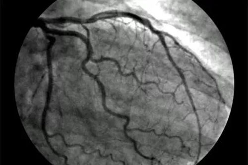 心脏冠状动脉造影你知多少