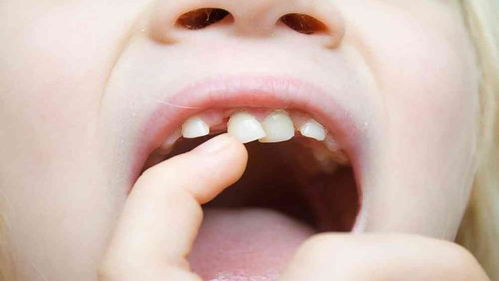 导致孩子 满口烂牙 的可不仅仅是吃糖果,还有家长的这种习惯