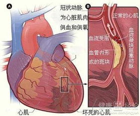 心肌梗塞的主要原因(引起心梗的主要原因是什么)