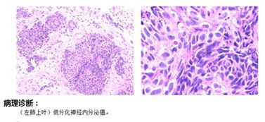 未见DNA陪体异常细胞 DNA指的是什么?以上指的是重度宫劲糜烂