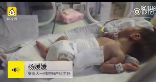 孕妇怀双胞胎流产,医生说 还能抢救一下 ,24天后生下弟弟