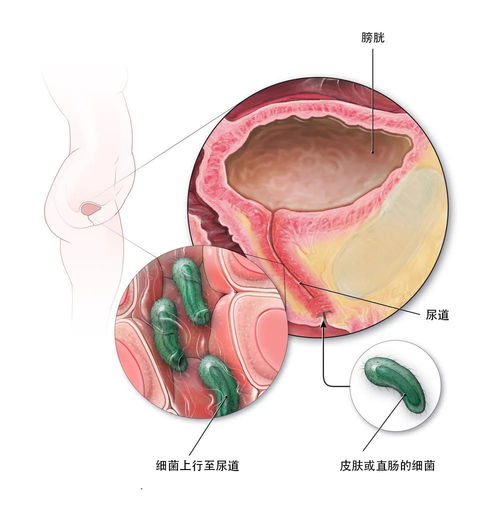 警惕！尿路感染的早期症状，你留意了吗？