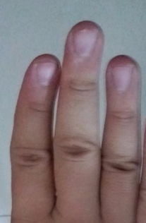 我的手指骨头长得是弯曲的和歪的,是遗传我爸的,手指骨头长得弯曲和歪就是因为遗传 有别的原因吗 