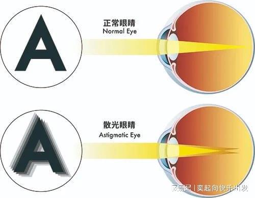 预防散光的4个好方法(如何预防散光和近视)