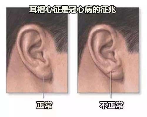 耳垂折痕是冠心病信号 有没有道理呢 答案就在文中