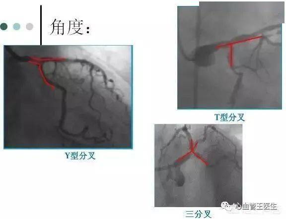 做完心脏支架都要复查血管造影吗 什么时间复查最合适 一次说清