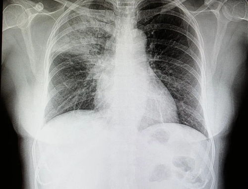 AI再出力,可通过胸部X光片检测新冠