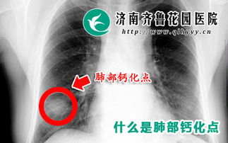 肺部有钙化点是什么意思