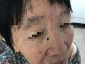 70岁奶奶想点掉脸上新长的 美人痣 ,医生一看却直呼 危险