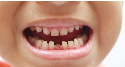 孩子乳牙整齐漂亮,换牙后却越长越丑 这些 毁牙 习惯孩子有吗