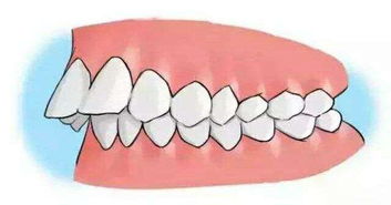 牙齿不齐的6种形式,为什么你的牙齿会长歪