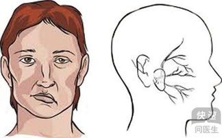 半边脸面瘫的原因 警惕半边脸面瘫3大危害