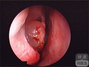 鼻息肉的药物治疗方法 3种方法治疗鼻息肉