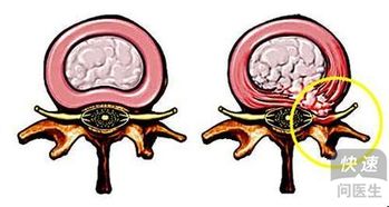 腰间盘突出偏方