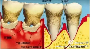 圣贝口腔医生告诉你 怎么预防牙周病你gait了吗