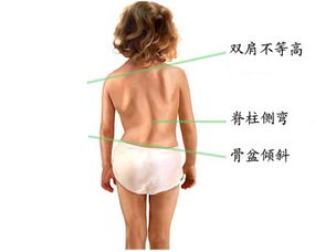 警惕！儿童脊柱侧弯：早期识别与预防的重要性