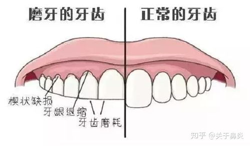 磨牙 是怎么回事 听我来分析分析 