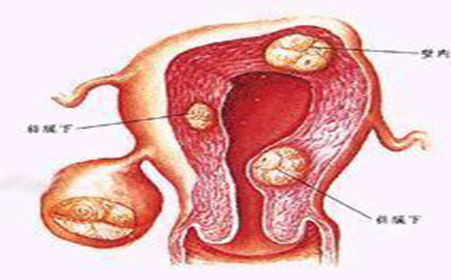 女性前庭大囊肿图片 