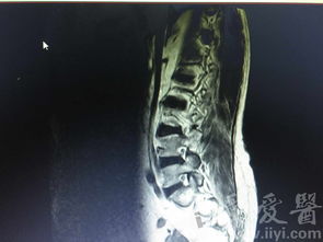 腰椎横突骨折图片 搜狗图片搜索