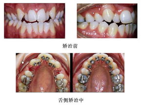 牙列不齐的疾病治疗 