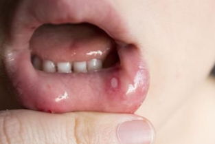 口腔溃疡与单纯疱疹怎样区别