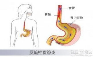 食道糜烂是反流性食管炎吗