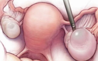什么是良性卵巢囊肿呢