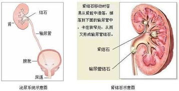 输尿管结石患者,你的结石适合哪一种治疗方式呢